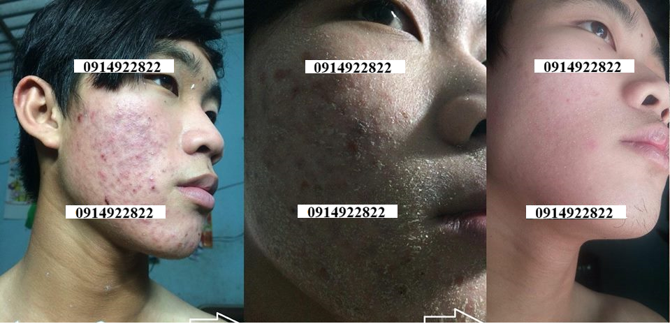 Trị Mụn Cao Cấp Mộc Lan - sạch mụn với chỉ từ 250k - 3