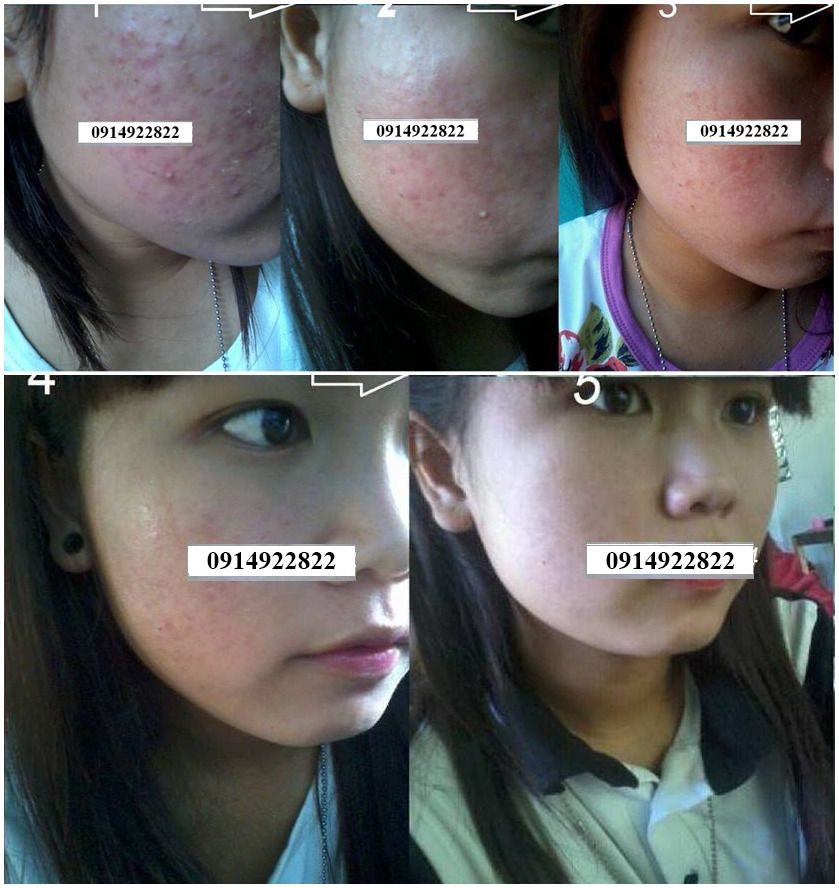 Trị Mụn Cao Cấp Mộc Lan - sạch mụn với chỉ từ 250k - 4