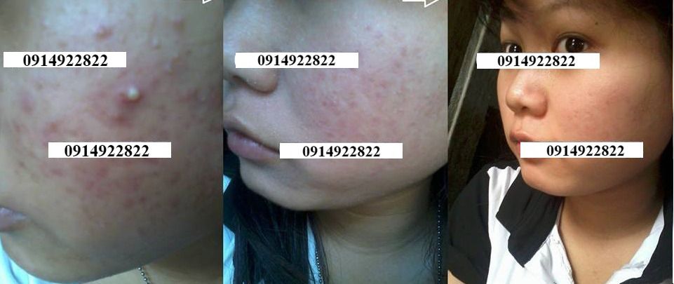 Trị Mụn Cao Cấp Mộc Lan - sạch mụn với chỉ từ 250k - 2