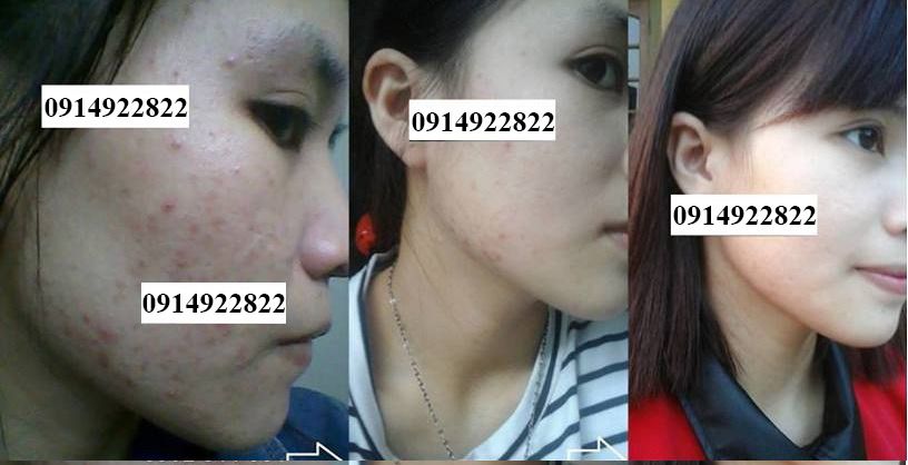 Trị Mụn Cao Cấp Mộc Lan - sạch mụn với chỉ từ 250k - 1